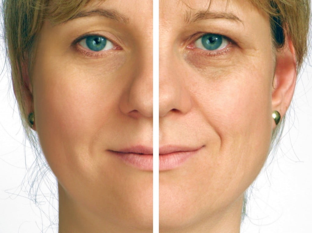 Correction of wrinkles on half of face